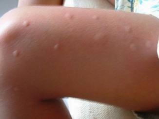 piqure de moustique
